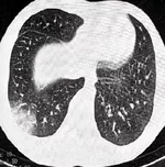 Подростков с «попкорновой» болезнью лёгких экстренно увезли в реанимацию после курения вейпов.webp