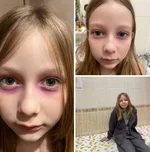 Мать года неделю лечила дочь от «редкой болезни» с розовыми кругами под глазами.webp