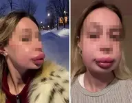 Москвичка не могла принять свою внешность и десятки раз увеличивала губы.webp
